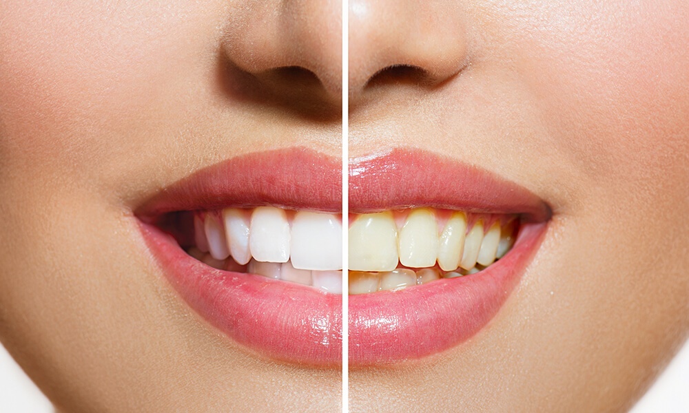 Teeth-whitening